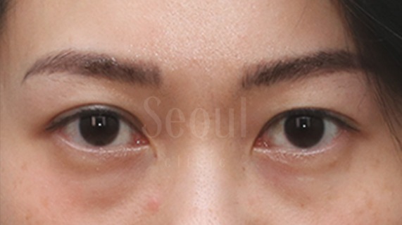 眼袋_術前分享_首爾醫美