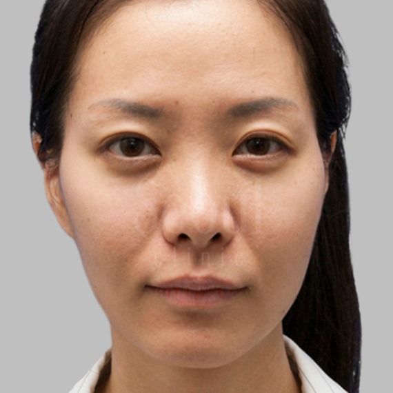 洢蓮絲_術前案例_首爾醫美