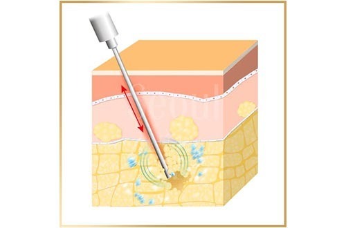 抽脂手術_手術方式_首爾醫美