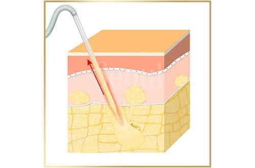 抽脂手術_手術方式_首爾醫美