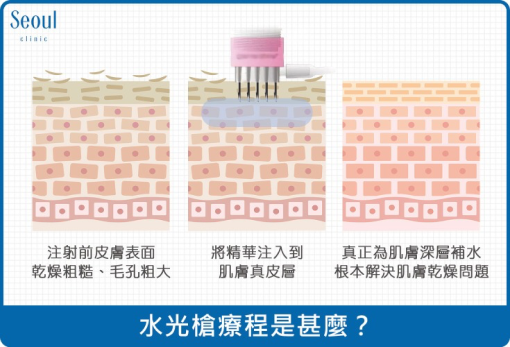 水光針-水光針療程是什麼？-首爾醫美