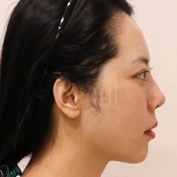 埋線拉提_術後分享_首爾醫美