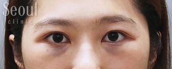 眼袋手術_術後當下_首爾醫美