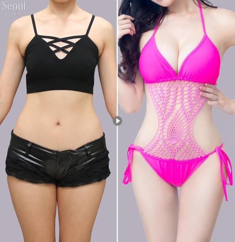 自體脂肪隆乳_術前術後_首爾醫美