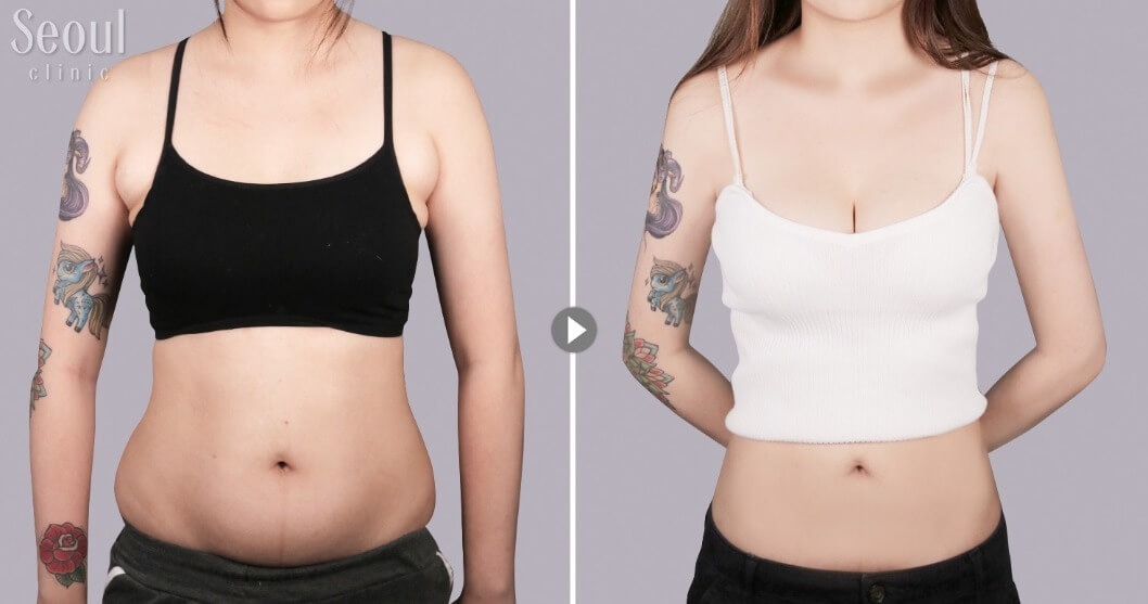 抽脂手術_術前術後_首爾醫美
