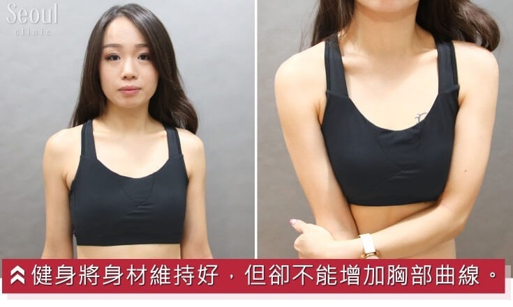 果凍隆乳_故事案例_首爾醫美