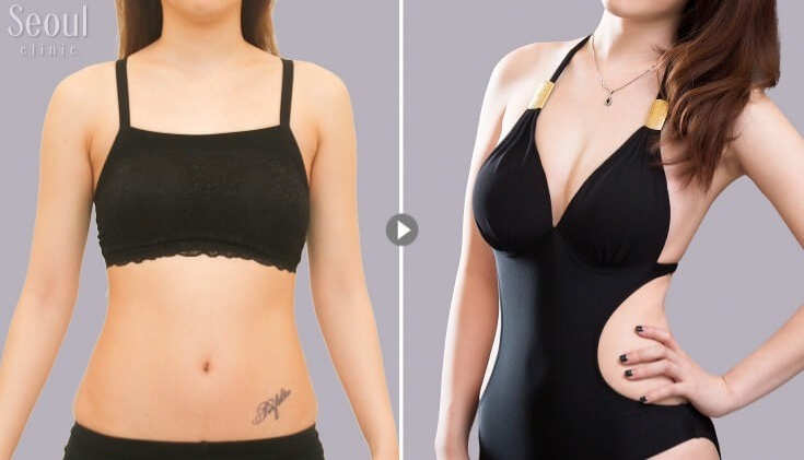 自體脂肪隆乳_術前術後_首爾醫美