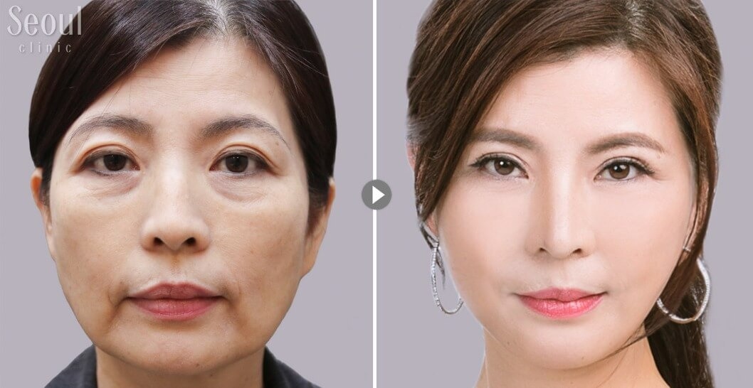 拉皮手術_術前術後_首爾醫美