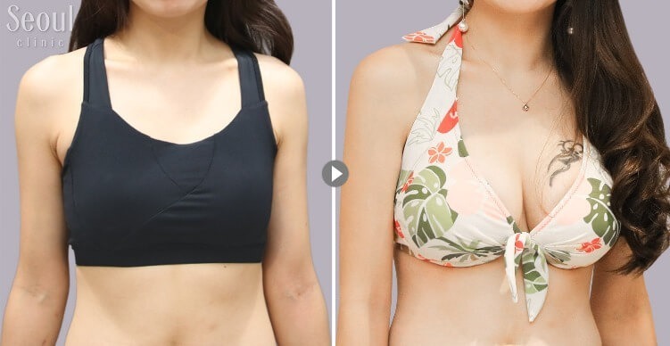 果凍隆乳_術前術後_首爾醫美