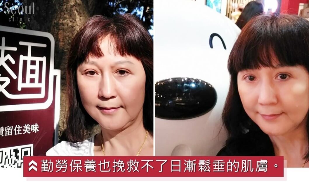 拉皮手術_術前術後_首爾醫美
