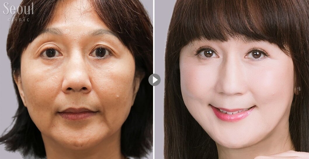 拉皮手術_術前術後_首爾醫美