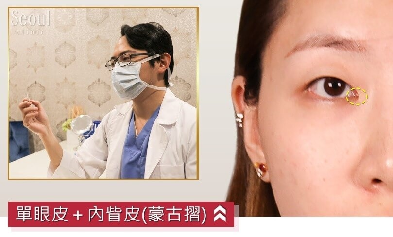 雙眼皮_蒙古摺_首爾醫美