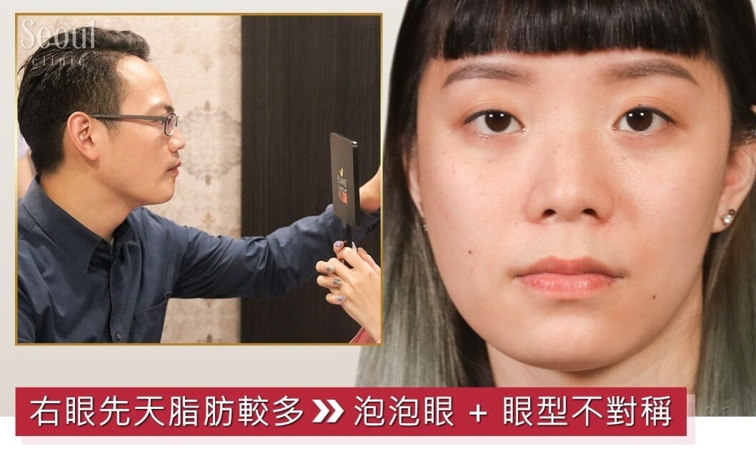 雙眼皮_諮詢過程_首爾醫美