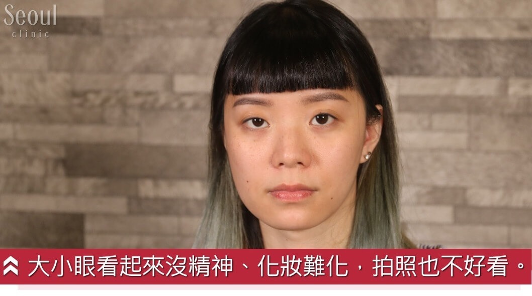 雙眼皮_故事案例_首爾醫美