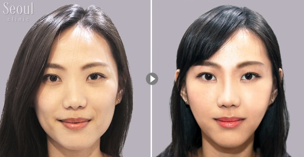 玻尿酸_術前術後_首爾醫美