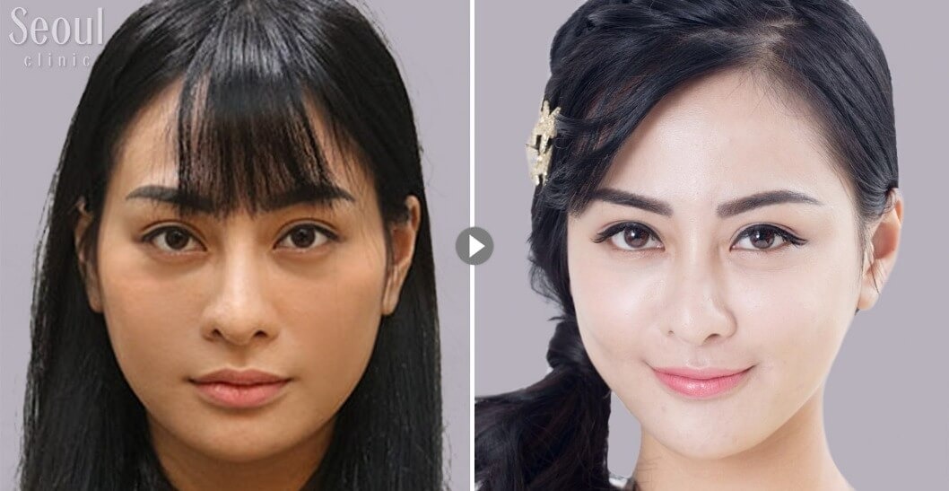 自體脂肪補臉_術前術後_首爾醫美