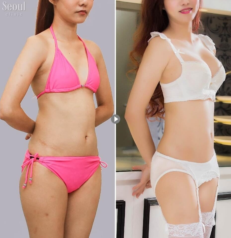 自體脂肪隆乳_術前術後_首爾醫美