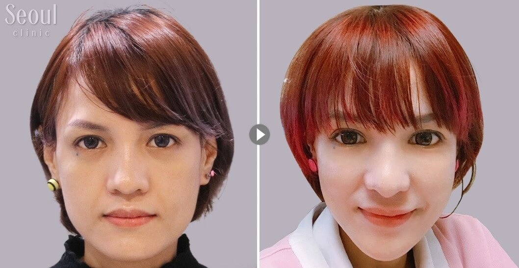 玻尿酸_術前術後_首爾醫美