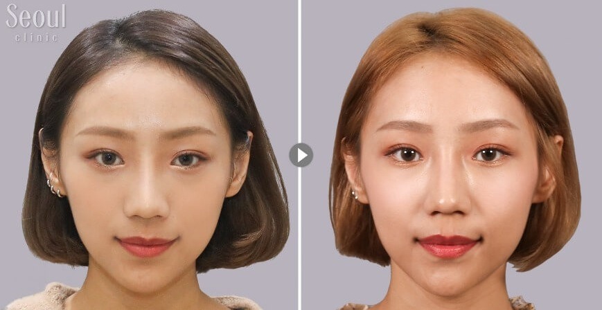 玻尿酸_術前術後_首爾醫美