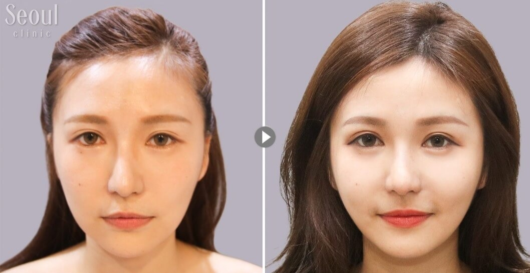 玻尿酸_術前術後_首爾醫美