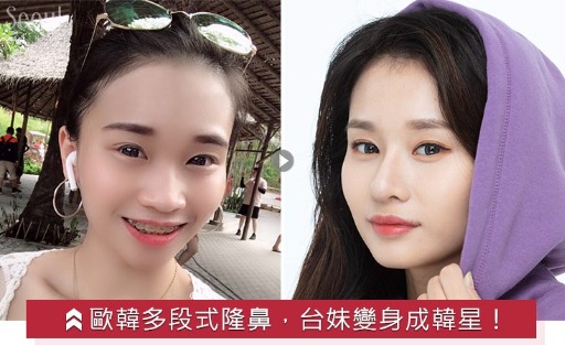 隆鼻手術_術後分享_首爾醫美