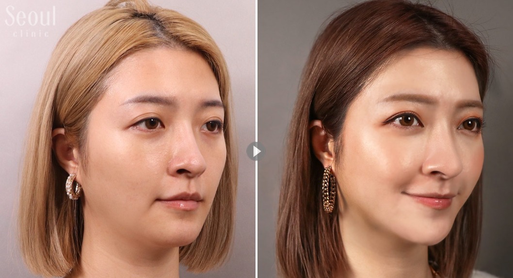 自體脂肪補臉_治療前後_首爾醫美