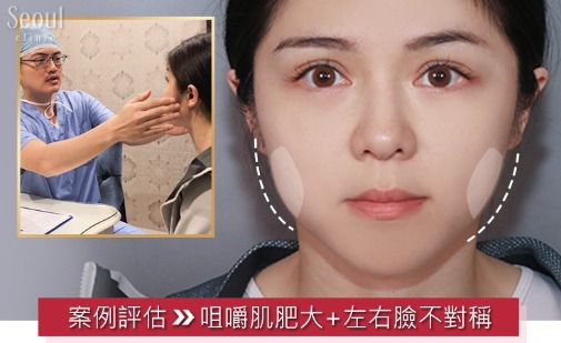 咀嚼肌肥大左右臉不對稱_首爾醫美