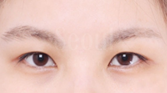 割(縫)雙眼皮手術_術前術後_首爾醫美