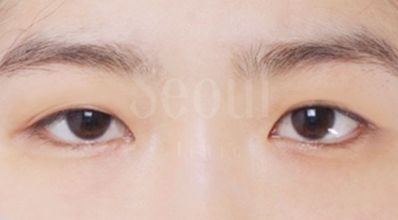 雙眼皮_下垂型雙眼皮_首爾醫美