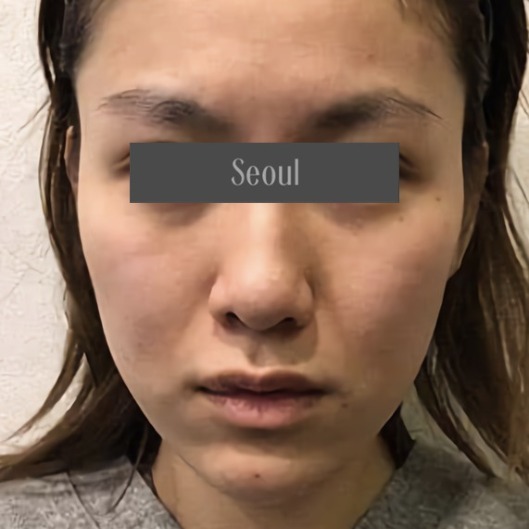 首爾醫美自體脂肪豐頰_術前分享