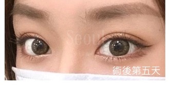 首爾醫美雙眼皮手術_技術介紹