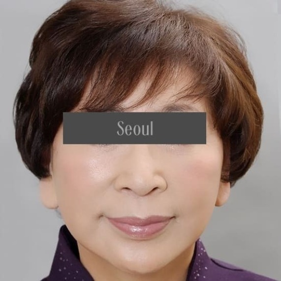 首爾醫美拉皮手術_術後分享照