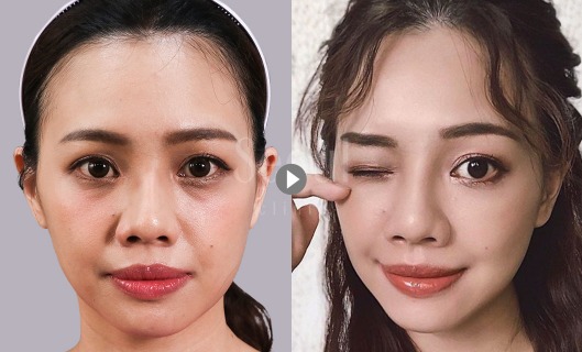 首爾醫美玻尿酸_網紅實證