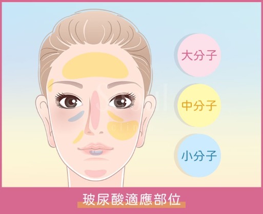 玻尿酸施打位置_首爾醫美診所