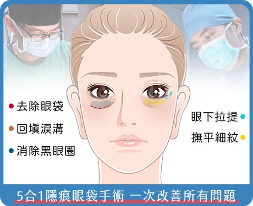 五合一隱痕眼袋手術_首爾醫美診所