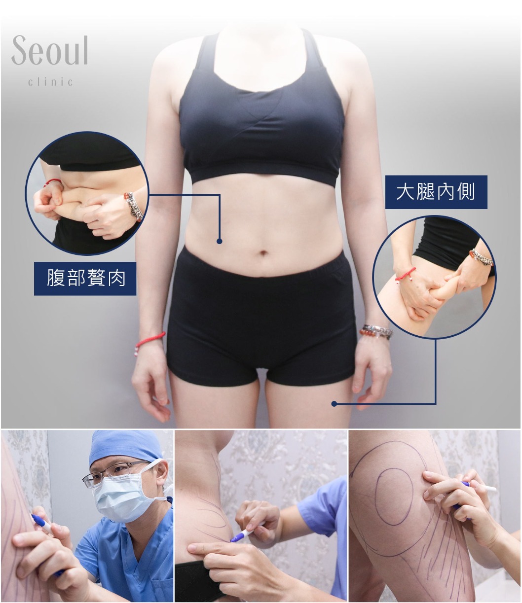 三合一雙重抽脂-腹部、大腿深層脂肪堆積-首爾醫美