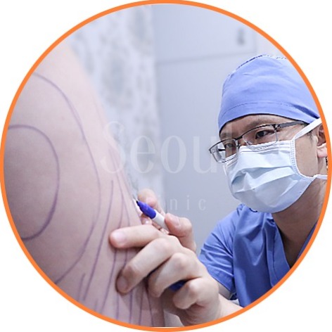 抽脂手術-術中修飾-首爾醫美