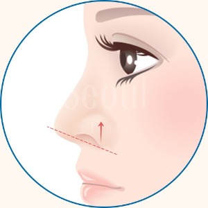 縮鼻翼手術_ 鼻翼後縮_首爾醫美