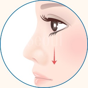 縮鼻翼手術_ 鼻翼下垂_首爾醫美