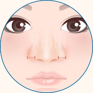 縮鼻翼手術_ 鼻翼過厚_首爾醫美