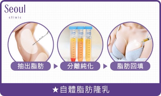 自體脂肪隆乳