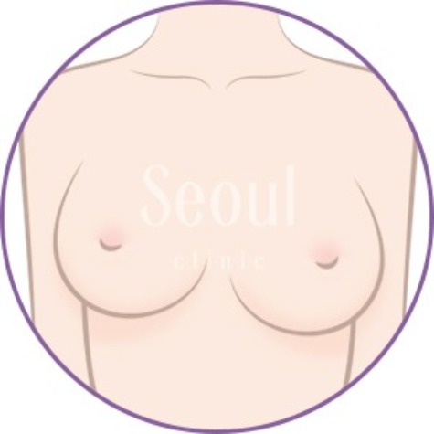 隆乳手術_不對稱型_首爾醫美