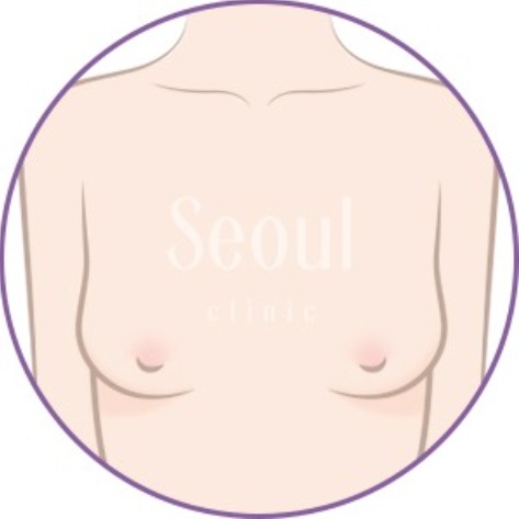 隆乳手術_細長型_首爾醫美