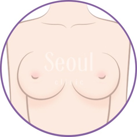 自體脂肪隆乳_邊界明顯_首爾醫美