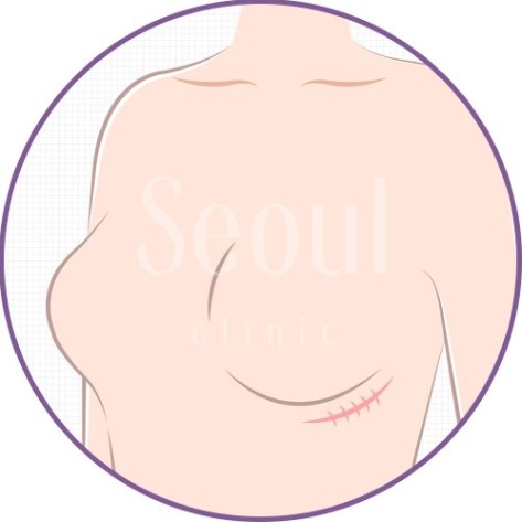 守則2_Q1_在意乳房有疤痕嗎