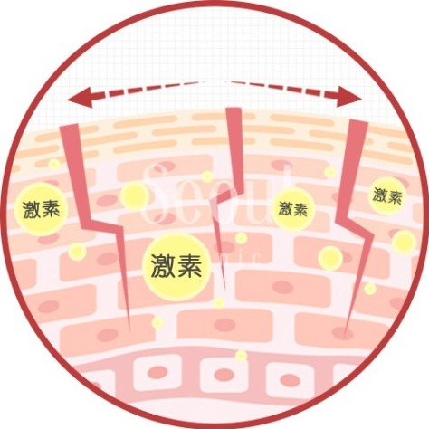 腹部拉皮_妊娠紋原因4_首爾醫美