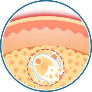 消脂針-注射消脂針後脂肪分裂-首爾醫美