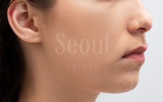 首爾醫美抽脂手術_術後分享照