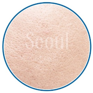 水光針-毛孔粗大-首爾醫美