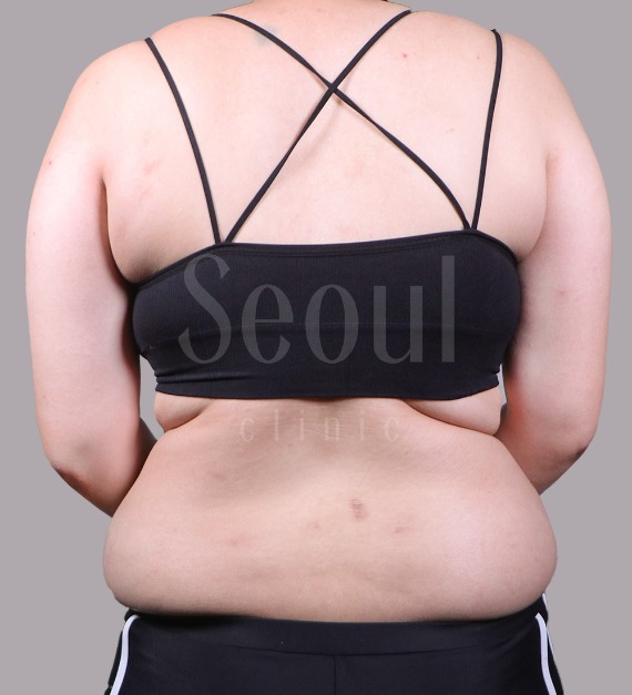 台中抽脂推薦-首爾醫美三合一抽脂手術-腹部抽脂術前分享照